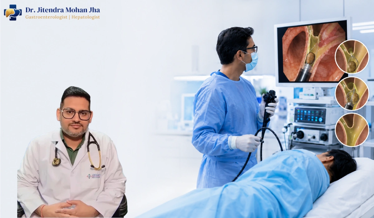 CBD Stone Removal and Treatment Cost in Patna