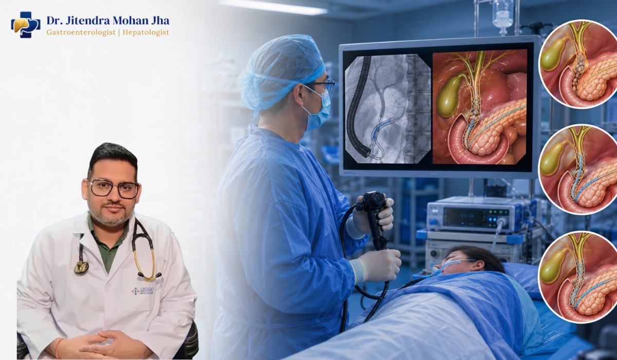CBD and PD Stenting in Patna