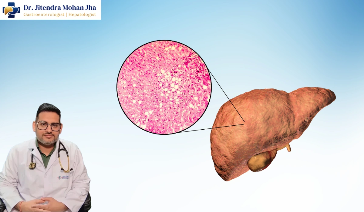 Fatty Liver Treatment in Patna